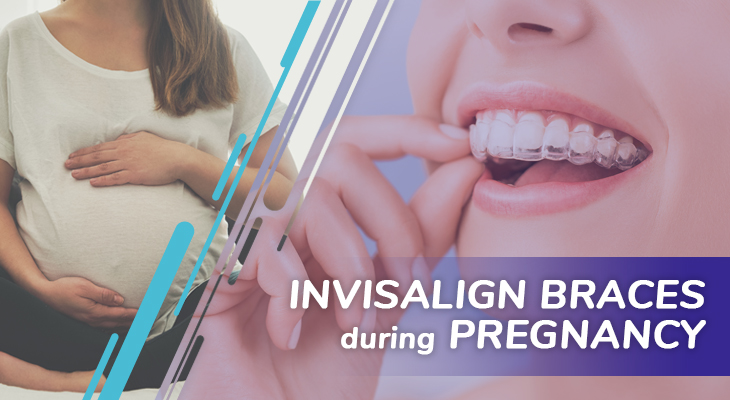 3 Crucial Things To Consider For Invisalign Braces During Pregnancy