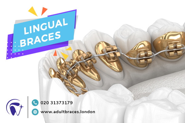 Lingual Braces London, Book A Consultation Today
